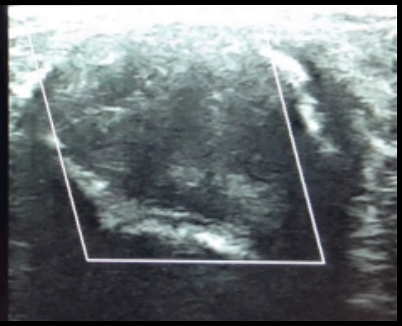 Rare and unusual occurrence of atypical fibroadenoma on ultrasound